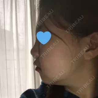 6日目の経過画像（2枚目）