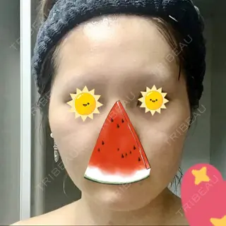 7日目の経過画像（1枚目）