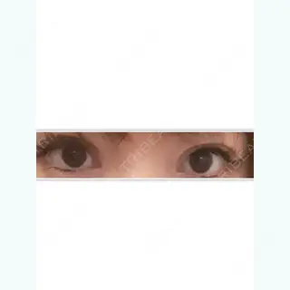 29日目の経過画像（1枚目）