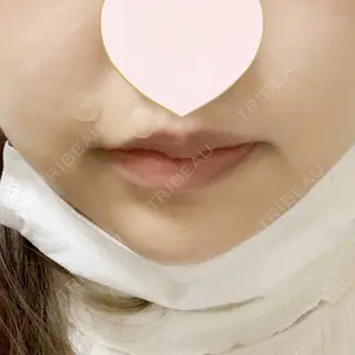 1日目の経過画像（1枚目）