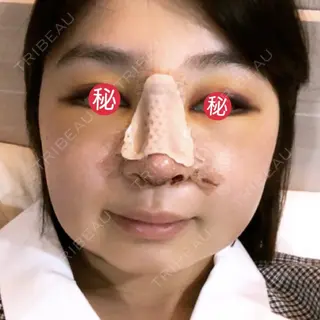 2日目の経過画像（1枚目）