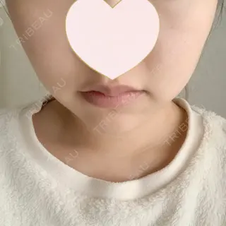 4日目の経過画像（1枚目）