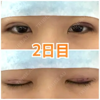 1日目の経過画像（1枚目）