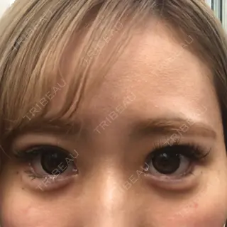 0日目の経過画像（1枚目）