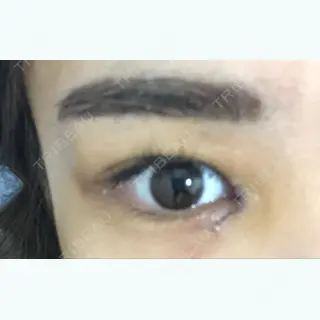 3日目の経過画像（2枚目）
