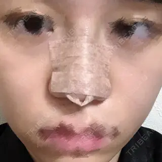 0日目の経過画像（1枚目）