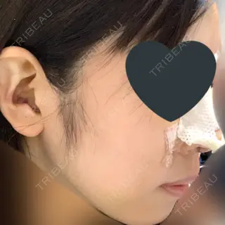 5日目の経過画像（1枚目）