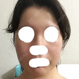 22日目の経過画像（1枚目）