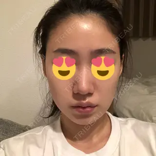 45日目の経過画像（2枚目）