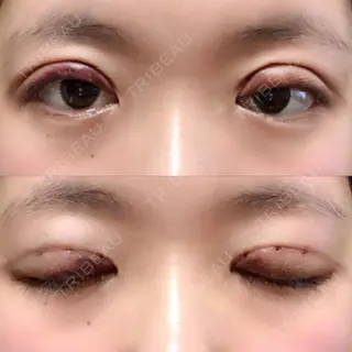 1日目の経過画像（1枚目）