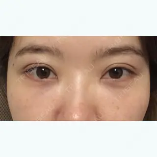 14日目の経過画像（1枚目）