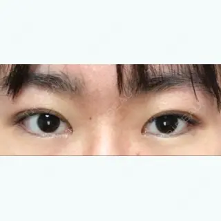 94日目の経過画像（1枚目）