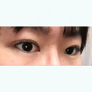 94日目の経過画像（2枚目）