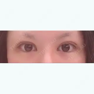 6日目の経過画像（1枚目）