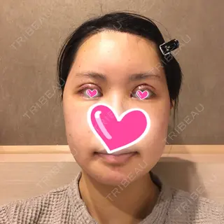 5日目の経過画像（1枚目）