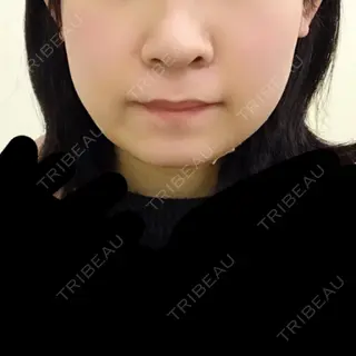 4日目の経過画像（1枚目）