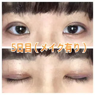 5日目の経過画像（2枚目）