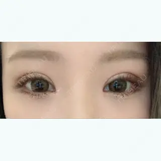 21日目の経過画像（2枚目）