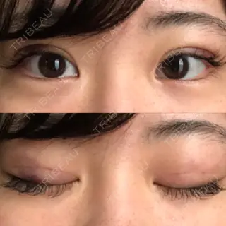 2日目の経過画像（1枚目）