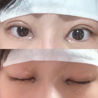 0日目の経過画像（1枚目）