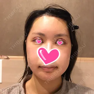 6日目の経過画像（1枚目）