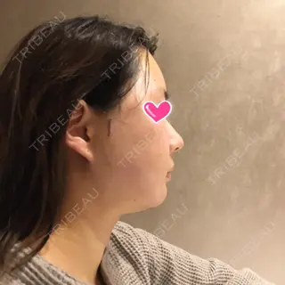 6日目の経過画像（2枚目）