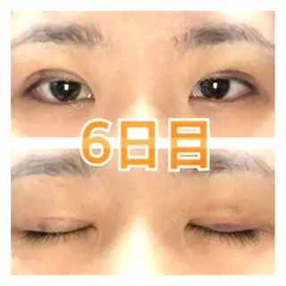 6日目の経過画像（1枚目）