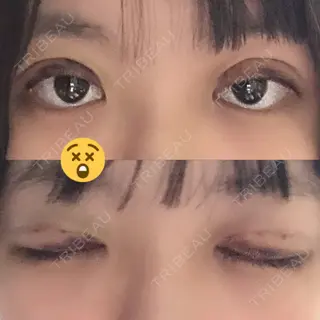 3日目の経過画像（1枚目）