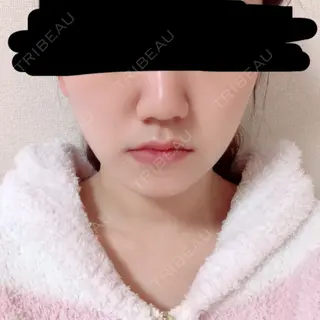 47日目の経過画像（1枚目）