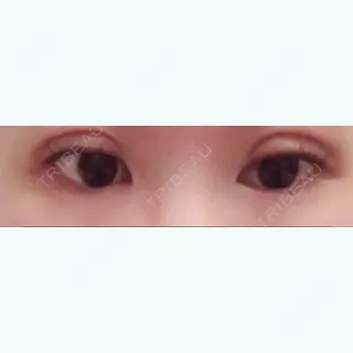 8日目の経過画像（1枚目）