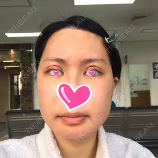 7日目の経過画像（1枚目）