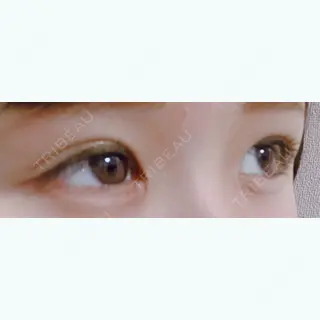 10日目の経過画像（2枚目）
