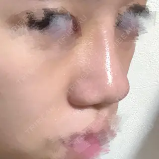 4日目の経過画像（2枚目）