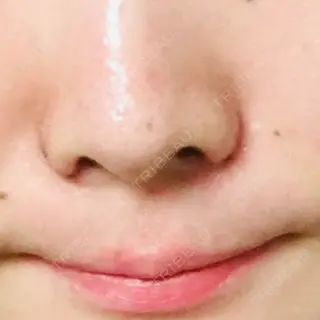 6日目の経過画像（1枚目）