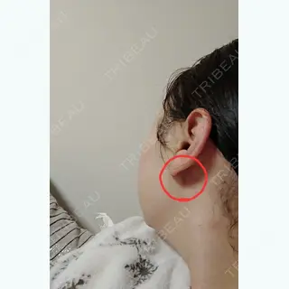 11日目の経過画像（2枚目）