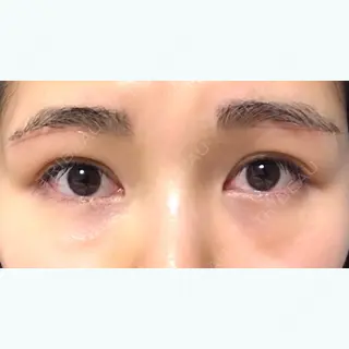 31日目の経過画像（1枚目）