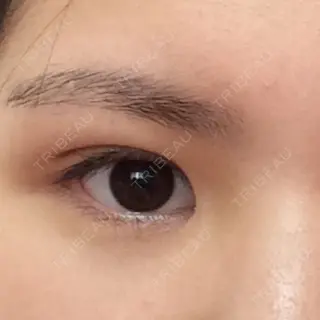 0日目の経過画像（1枚目）