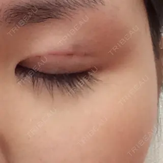 0日目の経過画像（3枚目）
