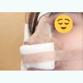 0日目の経過画像（1枚目）