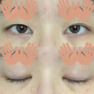 7日目の経過画像（1枚目）