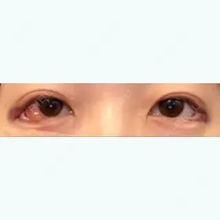 0日目の経過画像（1枚目）