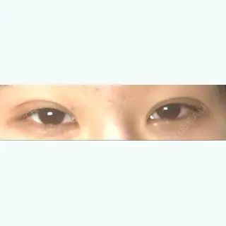 2日目の経過画像（1枚目）