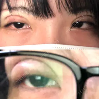 0日目の経過画像（1枚目）