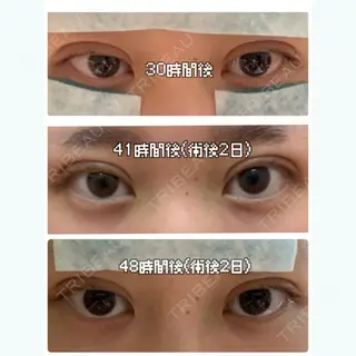 2日目の経過画像（1枚目）