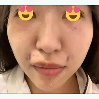 1日目の経過画像（1枚目）