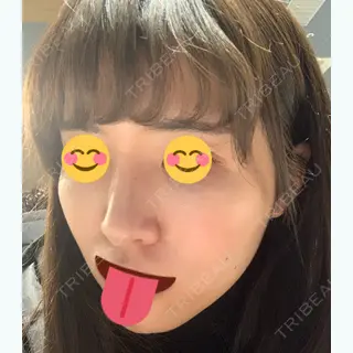 93日目の経過画像（2枚目）
