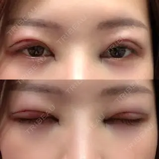 0日目の経過画像（2枚目）