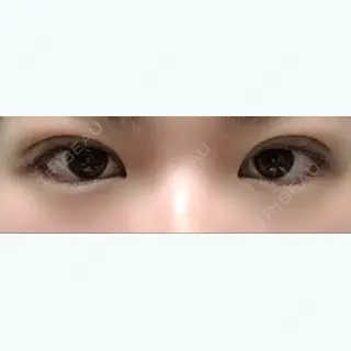 13日目の経過画像（1枚目）