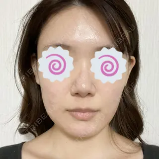 1日目の経過画像（1枚目）
