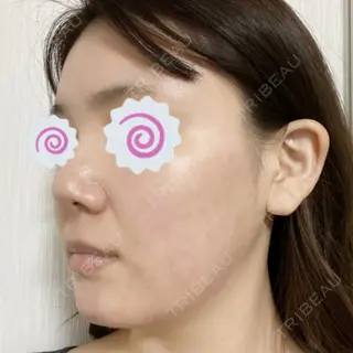 1日目の経過画像（3枚目）
